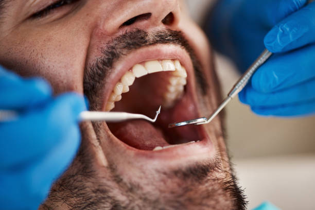 Best Emergency Tooth Extraction in Mulberry, NC