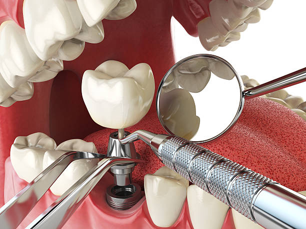 Best Emergency Tooth Extraction in Mulberry, NC
